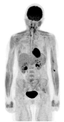 Imaging Lymphoma With F-18 Fluorodeoxyglucose PET-CT: What Should Be Known About Normal Variants, Pitfalls, and Artifacts?